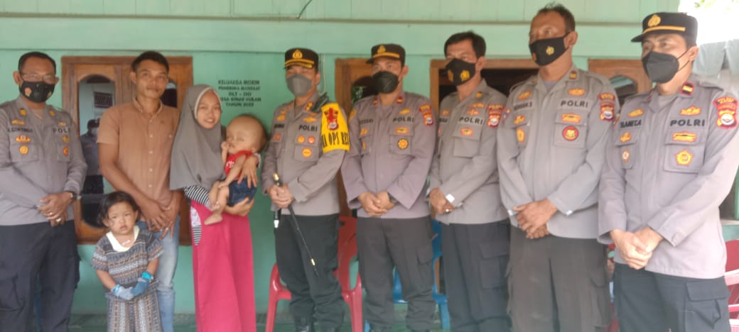 Bayi Arka Derita Hidrosefalus Sejak Lahir