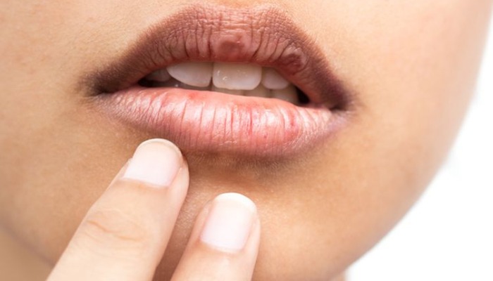 3 Penyebab Bibir Hitam yang Mungkin Belum Kamu Tahu dan Cara Praktis Kembali ke Warna Bibir Cerah!
